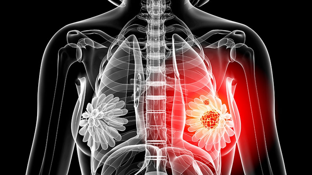 Graphic of skeleton with red radiating from left breast area