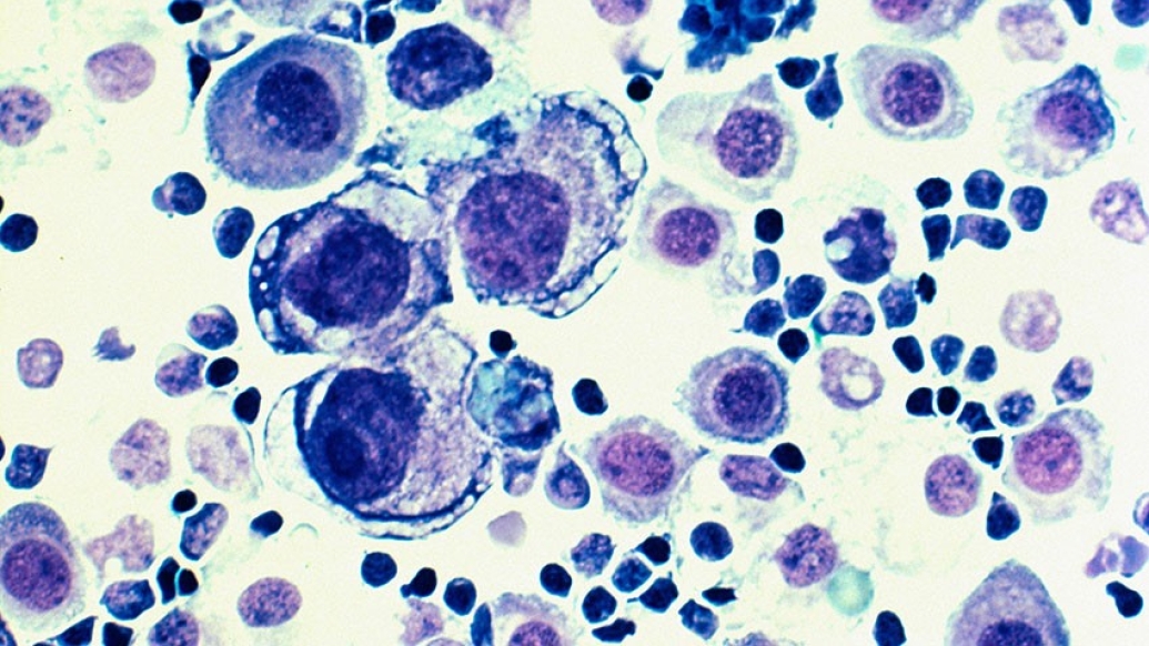 Image of purple and blue colored cells of metastatic breast cancer.