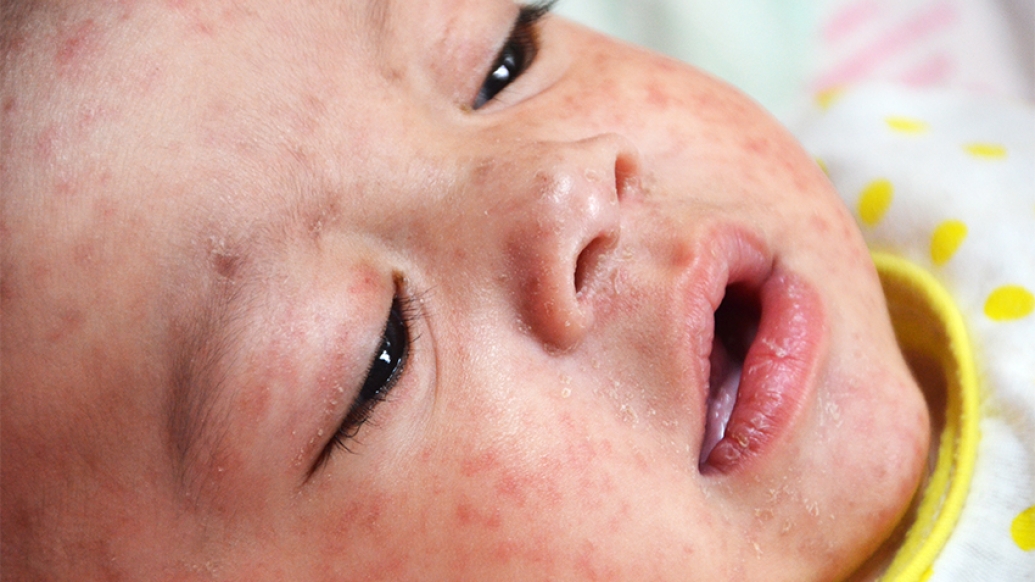 Small child with measles